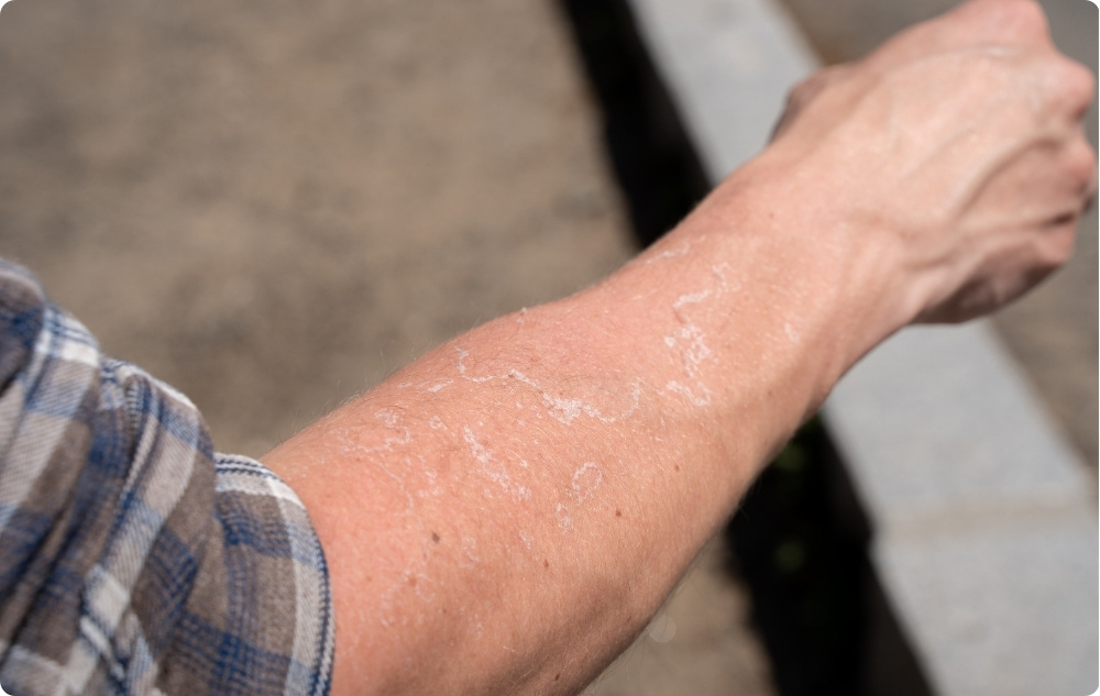 Öljynä ärtyneelle ja kuivalle iholle