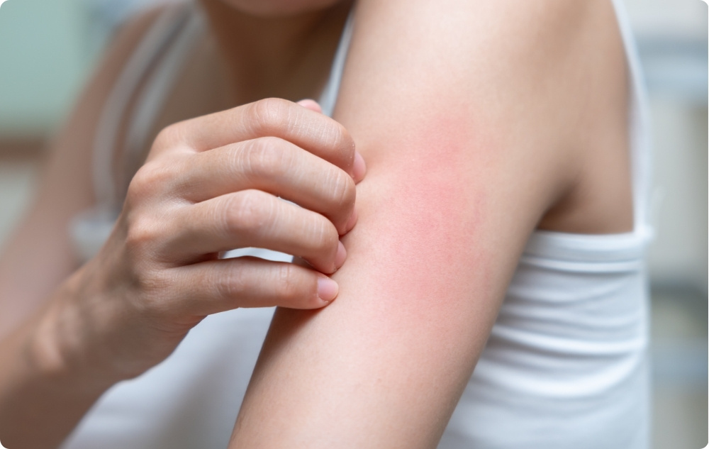 Rauhoittavana öljynä punoitukseen ja ärsytykseen